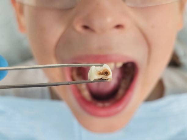 Best Emergency Treatment for Dental Infections or Abscesses in Lake Delta, NY