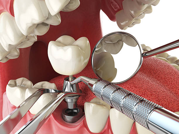 Best Emergency Dental Care for Broken or Chipped Teeth in Lake Delta, NY